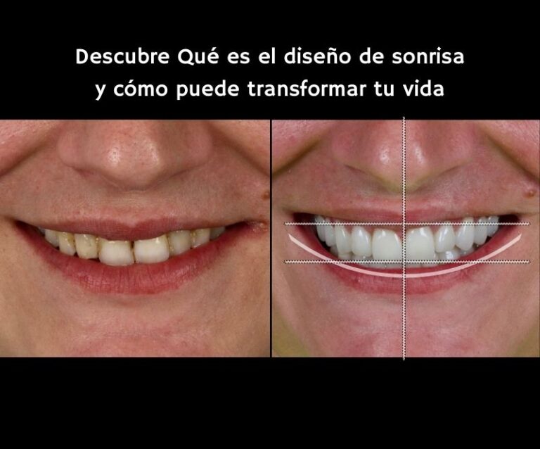 ¿Qué es el diseño de sonrisa y cómo puede transformar tu vida?- Víctor ...
